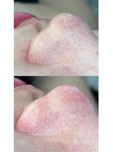 ロカヒ(Lokahi)/毛穴洗浄ビフォーアフター