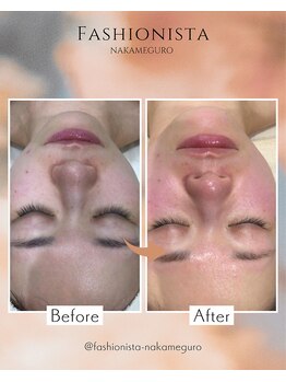 ファッショニスタ 中目黒店(Fashionista)/毛穴洗浄ビフォーアフター