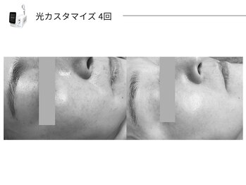 スパレーカ(Spa laka)/光カスタマイズ