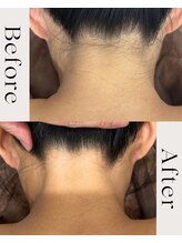 ピース(PEACE)/うなじワックス脱毛