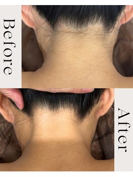 ピース(PEACE)/うなじワックス脱毛