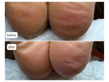 カシェット(Cachette)/50代女性◎足裏角質ケア90分