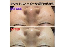 コルッソ(CoLusson.)の雰囲気（ホワイトスノーピール/速攻美白/ハリ/艶肌肌質改善/シミ/シワ）