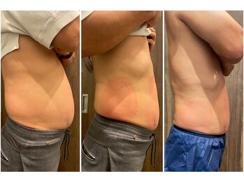 ビュウナ 銀座(BEAUNA)/脂肪冷却/frozen8