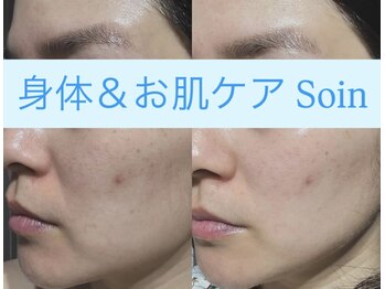 ソアン(Soin)/