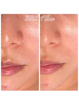 ルアナライフ(Luana Life)の写真/フェイスラインの弛み・首のシワ、くすみ・ハリ感にお悩みの方へ！自信あふれる肌へ♪