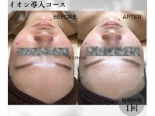エレンシア(E'lencia)の雰囲気（１回で変化実感！【毛穴・美白・肌質改善】化粧ノリもUP！！）