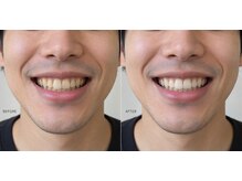 スムース ホワイトニング(SMOOOTH WAX)の雰囲気(セルフホワイトニングも人気です。歯科衛生士が在籍しています)