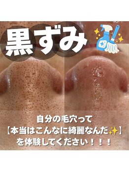 カナウ(KANAU)の写真/【毛穴洗浄×ハーブピーリング】ホームケアだけでお肌を綺麗にしていきたい方へ！月1回のリセット美容♪