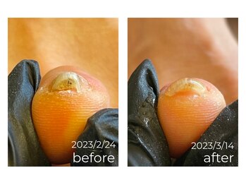 肥厚爪/巻爪《O様右足人差し指》