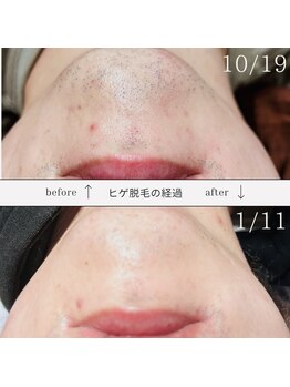 オフ(off)/脱毛ビフォーアフター