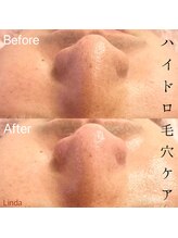 リンダ 西宮店(LINDA)/ハイドロ&プラズマシャワー