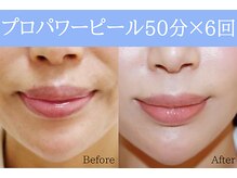 空 荻窪(くう)/プロパワーピール6回/3ヵ月