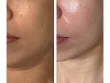 アドビューティ(Add Beauty)/≪プラズマフェイシャル≫