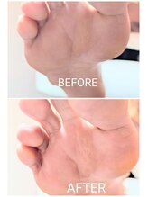 リヴィエール(Riviere)/60代女性　魚の目の痛み