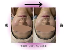 カリアンヌ/リンパフェイシャル/小顔/毛穴