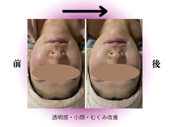 カリアンヌ/リンパフェイシャル/小顔/毛穴