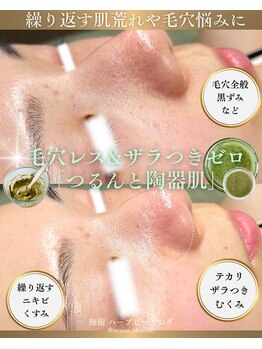 ソユ(SOYOU)/施術* ハーブピーリング