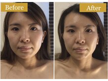 モモスパ(MOMOspa.)/頭蓋骨小顔矯正ビフォアフター