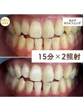 メガミノチカラ/セルフホワイトニング