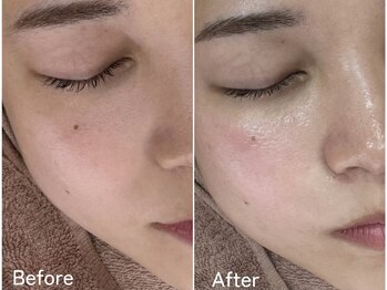 エマ(emma)/艶肌フェイシャルWAX＋水光肌