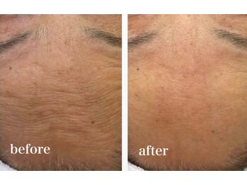 イリゼ(iriser)/ハーブピーリングBeforeAfter