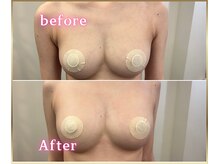 ジュエルリング(Jewel Ring)/症例写真バストアップ