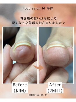 【巻き爪ケア】　50代女性