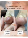 【巻き爪ケア】 50代女性