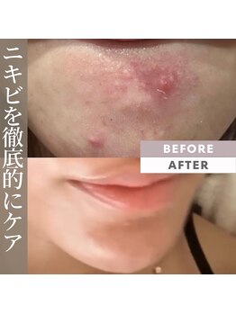 キレナル(KIRENAL)/カーボキシー炭酸パック