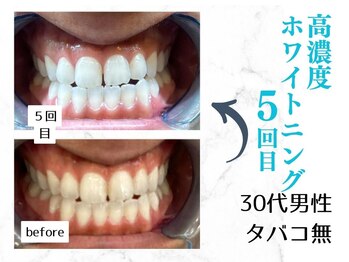 ルカノン(le canon)/芸能人級の白い歯ゲット！！