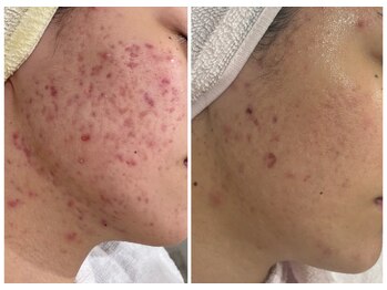 ハクビューティー(HAKU BEAUTY)/赤ニキビ/色素ケア/肌質改善