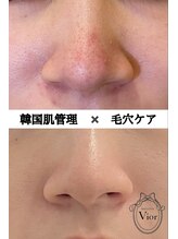 ヴィオール 名古屋栄店(VIOR) 毛穴悩み 黒ずみケア
