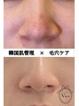 ヴィオール 名古屋栄店(VIOR) 毛穴悩み 黒ずみケア