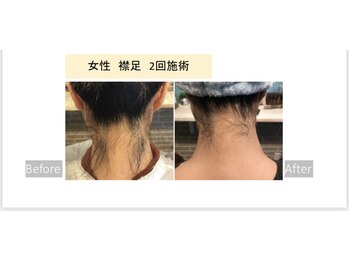 ル シェリア(Le Cherien)/最新マシンによる脱毛★