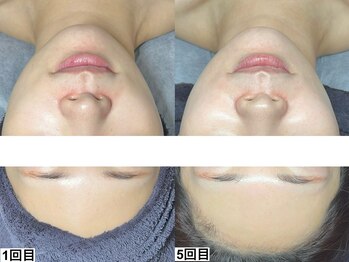 アンドミー 神戸元町店(&me)/ララピール【艶肌/美白/くすみ】