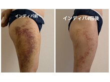 インディバサロン ジョリ(Jolie★)の雰囲気（Jolie★のインディバで術後ケアもお任せください！）