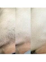 メンズサロンエヌエー(MEN'S SALON NA)/【全身脱毛もお任せ】胸毛脱毛