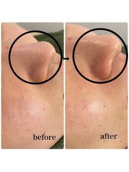 ラシック(Rachic)/クリスタルハーブピーリング☆