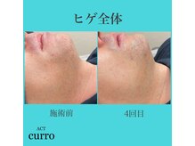 アクト クロ(ACT curro)/【ヒゲ全体】脱毛施術例