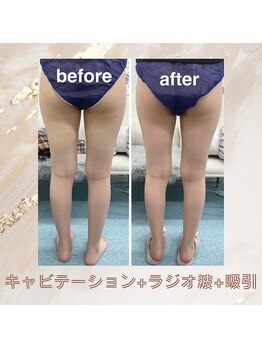 ハロ 南青山(HALO)/キャビテーション+ラジオ波+吸引