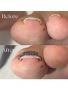 軽度巻き爪矯正ビフォーアフター