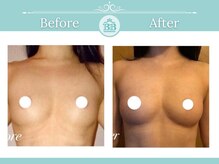美人バスト 浜松店/◇ バストアップ &nbsp;BeforeAfter◇