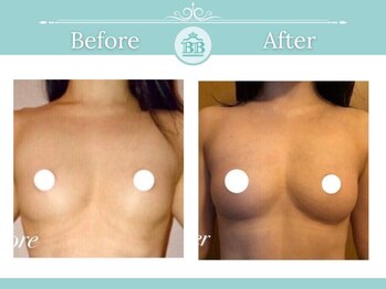 美人バスト 浜松店/◇ バストアップ &nbsp;BeforeAfter◇