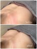 【ママ応援！垂れ胸改善】ボリューム&リフトアップ（写真アップOKな方）
