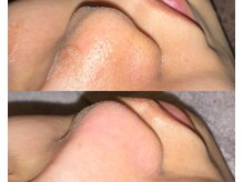 ル シーニュ/毛穴エクストラクション