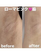 ミント(Mint)/【韓国発】ローマピンク★脇