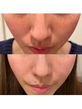 ジョンミー(JONMEE)/ハーブピーリングで驚きの透明感