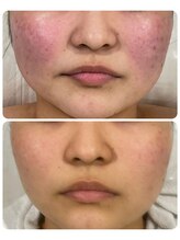 ハクビューティー(HAKU BEAUTY)/赤ら顔ケア