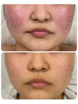 ハクビューティー(HAKU BEAUTY)/赤ら顔ケア